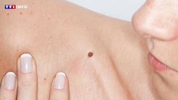 Savez-vous d'où viennent les grains de beauté ?  | TF1 INFO