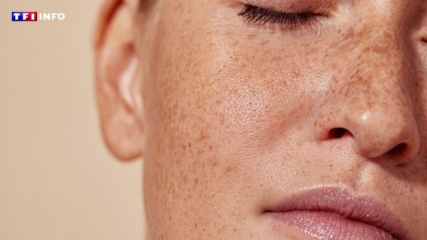 Taches de rousseur : pourquoi sont-elles plus présentes sur la peau en été ?  | TF1 INFO