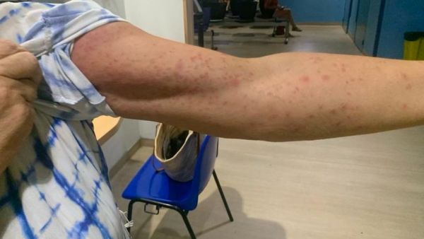 "Cela me provoque des brûlures insoutenables" : hospitalisée après une baignade dans un spa, une Catalane recouverte de boutons sur tout le corps depuis près d'un mois