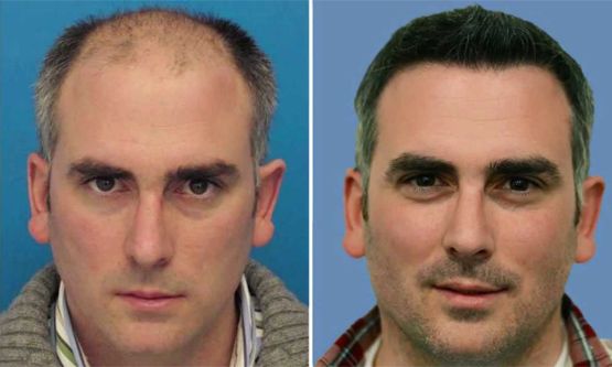Greffe FUE Tunisie - Implants capillaires | Cosmetic Tour
