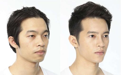 Canthopexie esthétique en Tunisie : Transformation des yeux