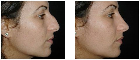 la rhinoplastie en tunisie : tout se qu'il faut savoir | Tourisme Médicale en Tunisie