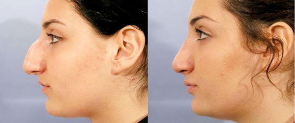 Rhinoplastie - méthode, prix, résultats avant / après | Tourisme Médicale en Tunisie
