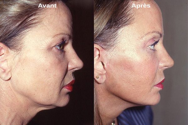 lifting cervico-facial : tout savoir sur cette opération | Tourisme Médicale en Tunisie