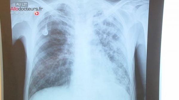 Tuberculose : un enfant décède dans le département de la Vienne
