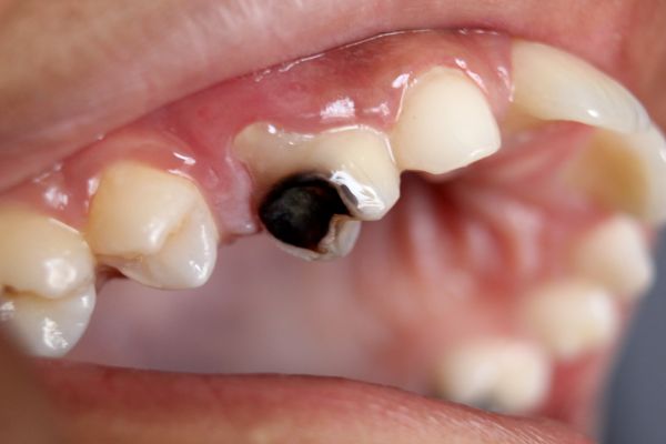 Des chercheurs ont trouvé un moyen de faire repousser l’émail des dents !