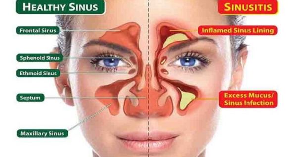 Comment déboucher naturellement les sinus obstrués seulement 1 minute ?