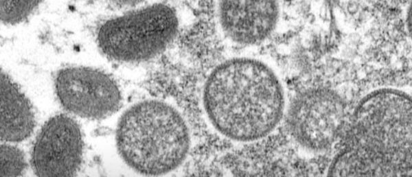 Plusieurs dizaines de cas suspects ou confirmés de variole du singe détectés depuis début mai en Europe et en Amérique du Nord, laissant craindre un début de propagation de cette maladie [...]