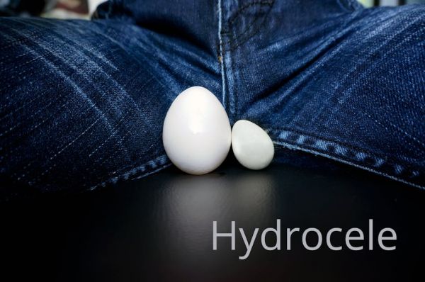 Hydrocèle : causes, traitements, c'est quoi ?