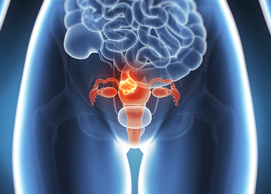 Le cancer du col de l’utérus tue plus de 300 000 femmes chaque année selon OMS