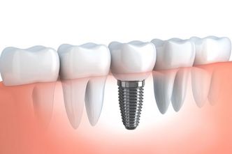 Implant dentaire Tunisie - Clinique chirurgie dentaire