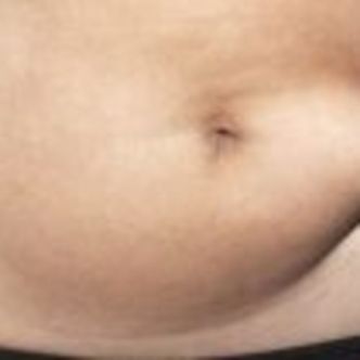 Une abdominoplastie, avant ou après la grossesse ?