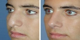 Rhinoplastie Tunisie à prix pas cher tout compris, Clinique de l'Espoir | Chirurgie esthétique tunisie