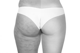 La cruroplastie pour lifter les cuisses et avoir les jambes tant convoitées