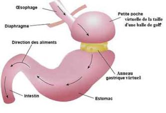 Anneau gastrique Tunisie - Prix pose anneau gastrique pas cher et tout compris, TCE