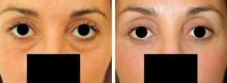 Blepharoplastie Tunisie : Prix chirurgie paupières, devis gratuit | Chirurgie esthétique en Tunisie
