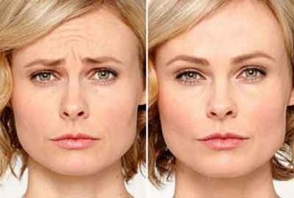 Botox en Tunisie
