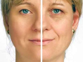 Devis injection plasma riche en plaquette peau, visage, cheveux en Tunisie