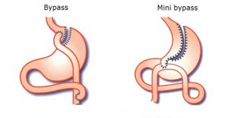 Bypass gastrique, chirurgie bariatrique