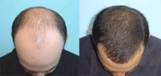 Greffe cheveux Tunisie : Prix greffe capillaire pas cher, Carthage Médical