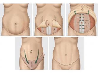 abdominoplastie tunisie : prix chirurgie esthetique ventre Tunisie