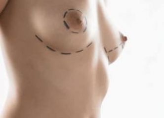 Réduction mammaire Tunisie, correction hypertrophie seins et diminution volume poitrine