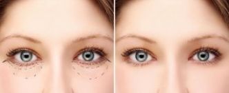 Blépharoplastie Tunisie : Chirurgie esthetique des paupieres