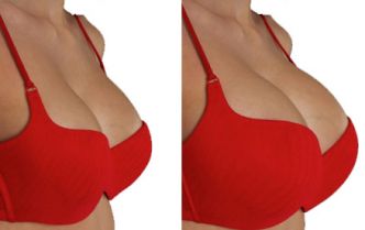 augmentation mammaire tunisie : avoir un sein plus ferme et plus féminin !