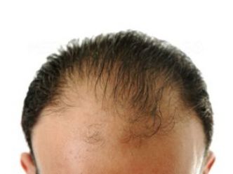 Greffe de cheveux tunisie : Implant sans cicatrices.