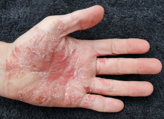 5 remèdes naturels contre le psoriasis