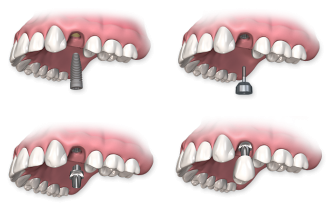 Quels sont les avantages des implants dentaires ?