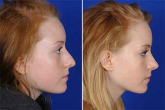 Rhinoplastie Tunisie : prix chirurgie esthetique nez pas cher