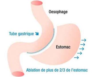Sleeve Tunisie : Prix sleeve gastrectomie pas cher