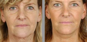 Lifting visage Tunisie : Le lifting du visage ou cervico-facial est un acte de la chirurgie esthétique du visage qui permet de traiter l'affaissement peau et muscles de l'ovale du visage et du [...]