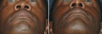 Rhinoplastie Tunisie : Chirurgie esthétique du nez à prix réduit