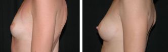 Augmentation mammaire Tunisie : Implants mammaires à prix réduit