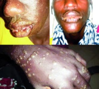 Maladie mystérieuse chez les pécheurs de Thiaroye – Hebdomadaire Révélations