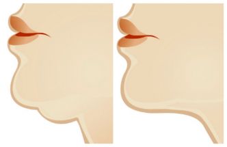 Exercices simples et efficaces pour se débarrasser rapidement du double menton