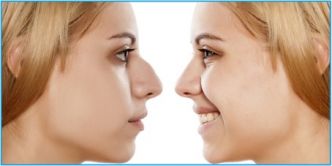 Comment se déroule une intervention de rhinoplastie en Tunisie ?