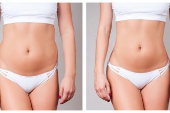Liposuccion du ventre : quand la faire, combien ça coûte ?