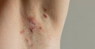 Maladie de Verneuil : une grande errance médicale