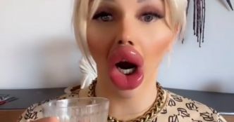 Cette femme aux lèvres énormes admet qu’il lui est difficile de boire et de manger