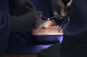 Mort du premier receveur de greffe de rein de porc génétiquement modifié