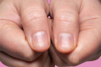 La cause des stries verticales sur vos ongles