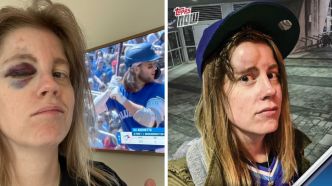 Après une fausse balle au visage, Topps l'immortalise sur une carte