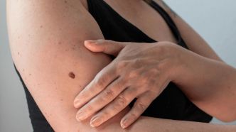 Est-ce grave de s'arracher un grain de beauté par mégarde ?