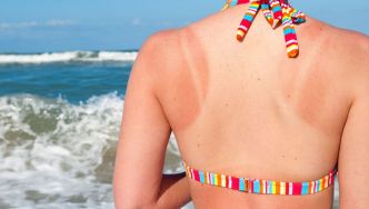 Nos conseils pour éviter les coups de chaleur et traiter les coups de soleil