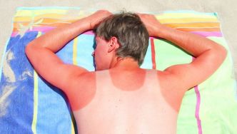 Comment soigner un coup de soleil ?