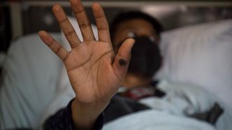 "Variole du singe": un premier cas de la nouvelle souche de mpox détecté en Thaïlande