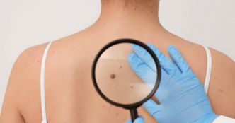 Santé. Après un cancer de la peau, ayez les bons réflexes pour en éviter un second